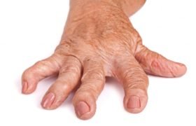 Ayurvedic treatment for arthritis