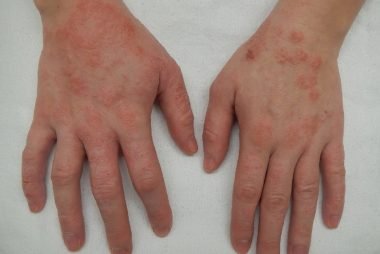 skin problems - Eczema Treatment