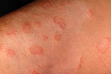 Ringworm Treatment