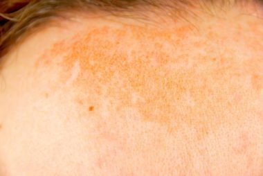 skin problems