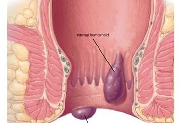 Ayurvedic piles treatment