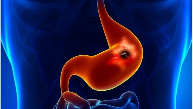 ayurvedic treatment for acidity
