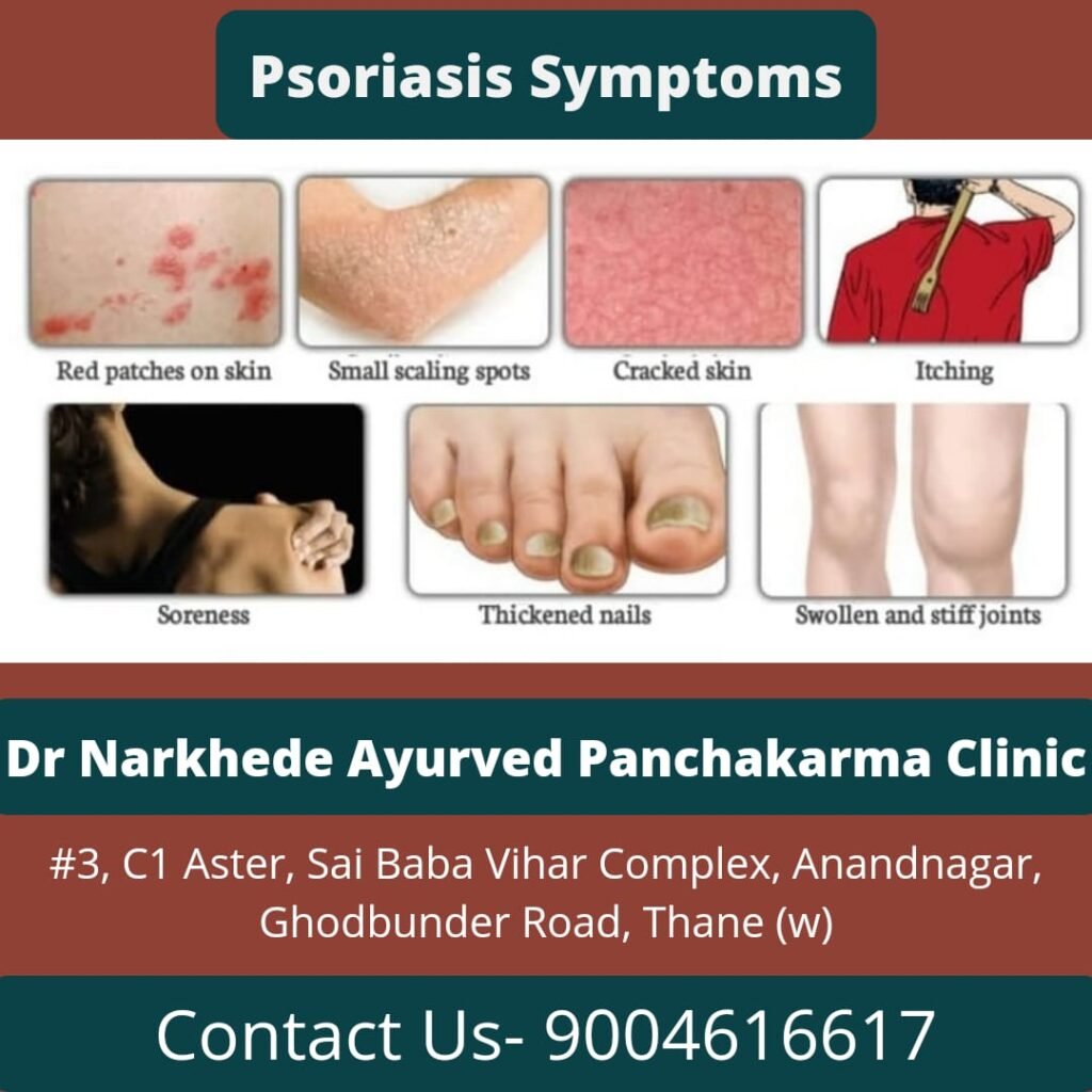 Ayurvedic treatment for psoriasis