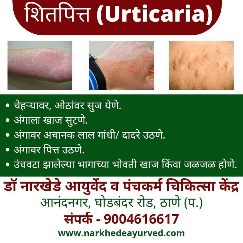 Ayurvedic treatment for urticaria