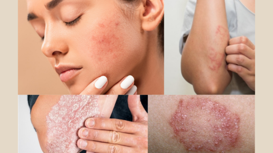 Ayurvedic Treatment for Skin Problems